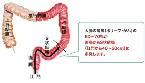 性転換大腸法|MtF / S字結腸 